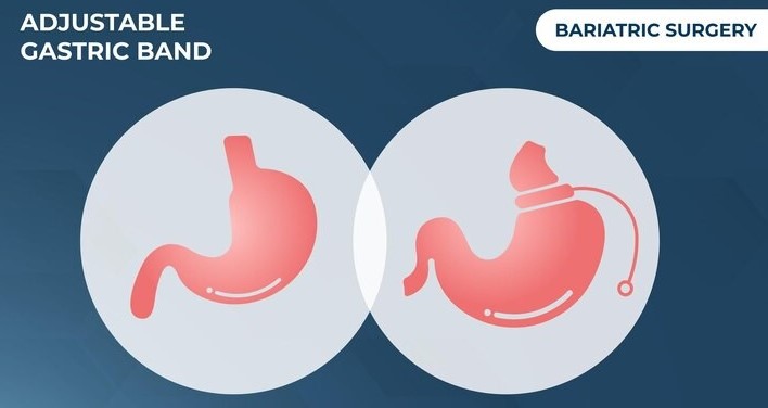 Gastric Bypass Surgery